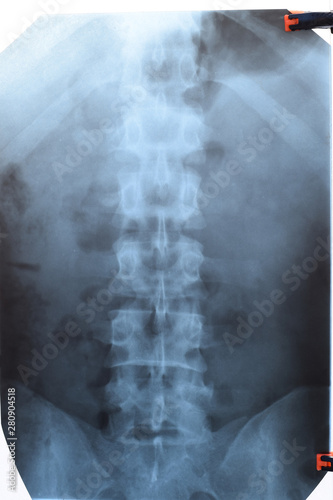 X ray of the lumbar spine, spine on x-ray photo