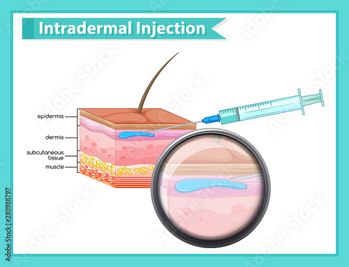 Scientific medical illustration of injection - Intradermal
