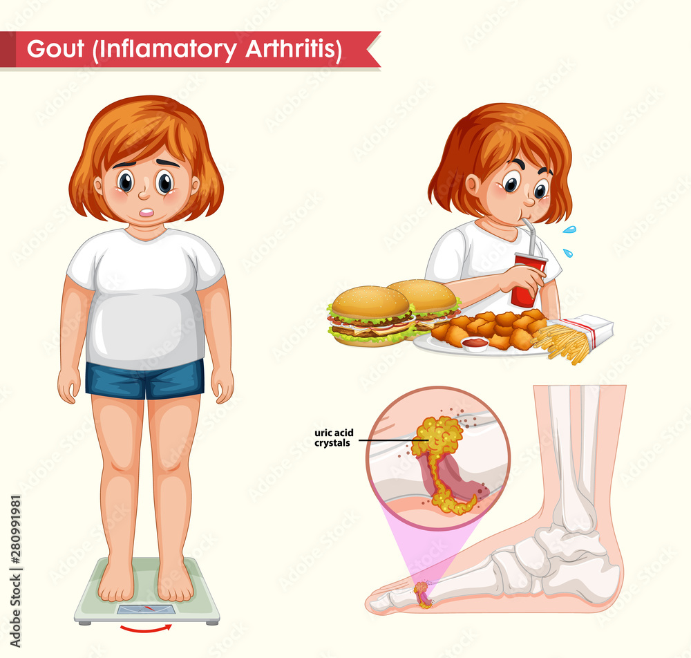 Scientific medical illustration of gout arthritis Scientific medical illustration of gout arthritis