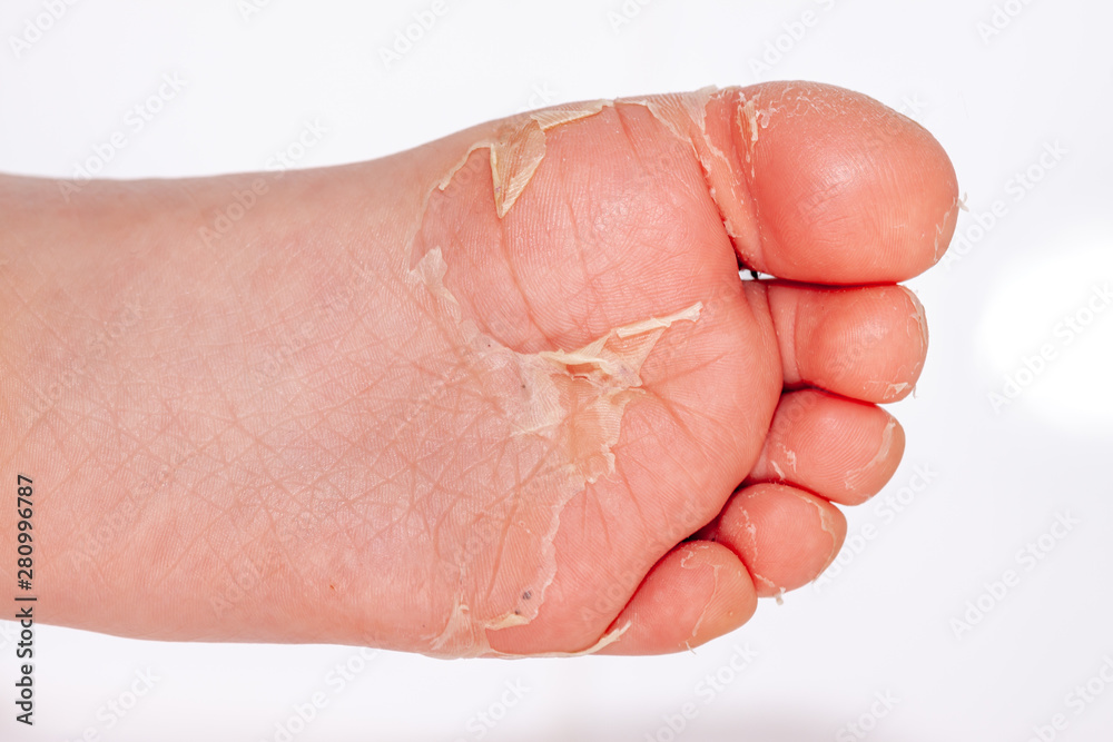 After the red rash and the strawberry tongue caused by scarlet fever the affected skin often peels - Here Skin of foot peeling After the red rash and the strawberry tongue caused by scarlet fever the affected skin often peels - Here Skin of foot peeling
