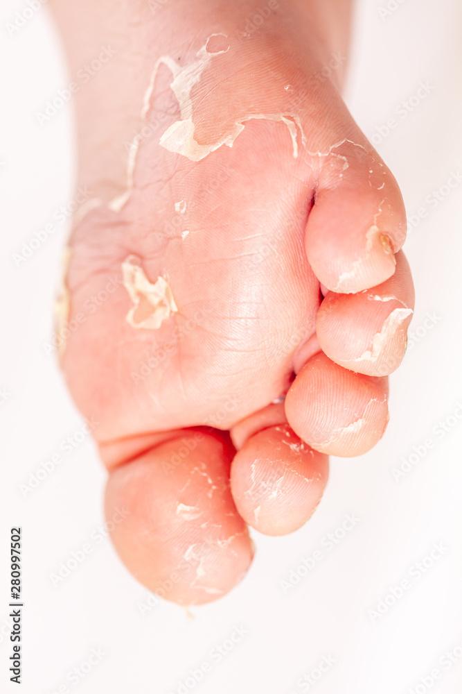 Fototapeta premium After the red rash and the strawberry tongue caused by scarlet fever the affected skin often peels - Here Skin of foot peeling
