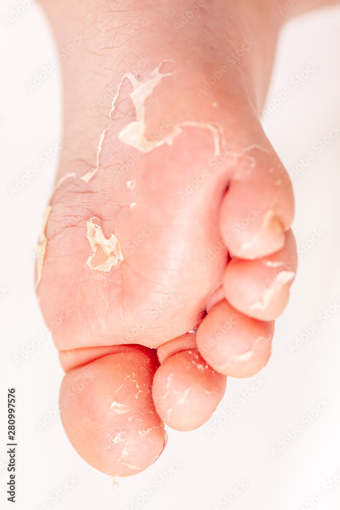 Fototapeta premium After the red rash and the strawberry tongue caused by scarlet fever the affected skin often peels - Here Skin of foot peeling