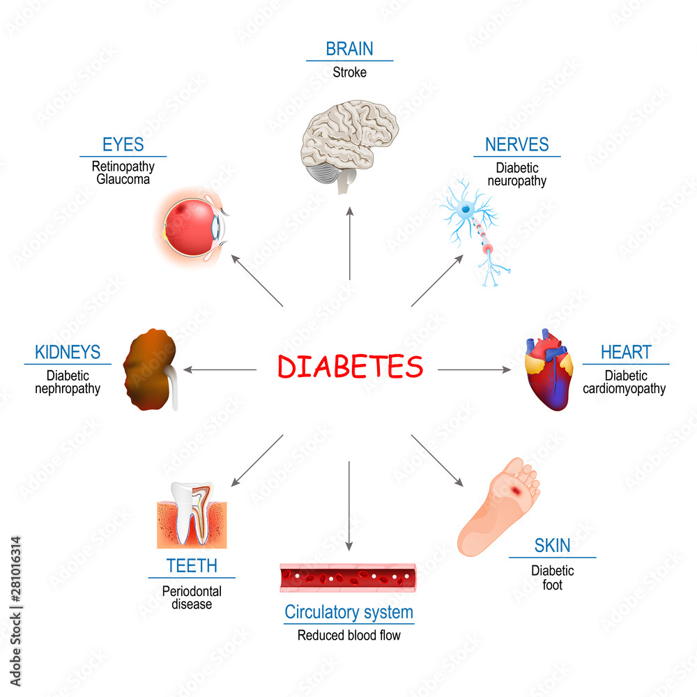 Diabetes Affects and Complications Stock Vector | Adobe Stock