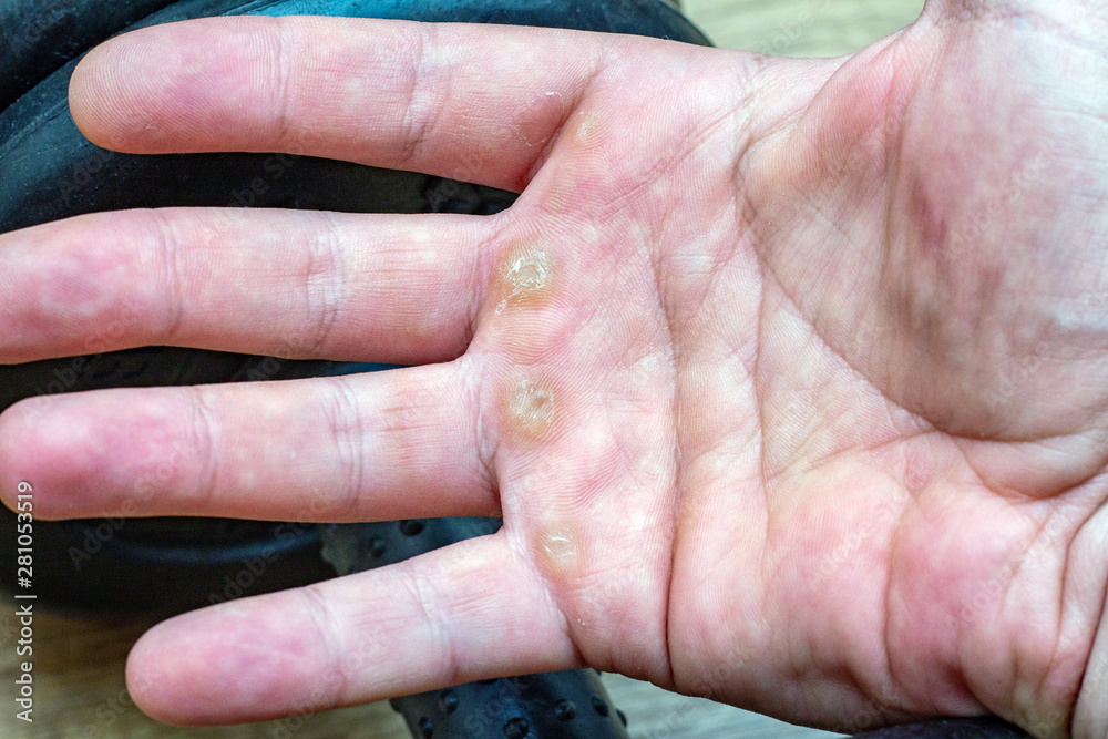 Hand with corn, callus, callosity, induration, congelation on the palm because of physical activity sports Hand with corn, callus, callosity, induration, congelation on the palm because of physical activity sports