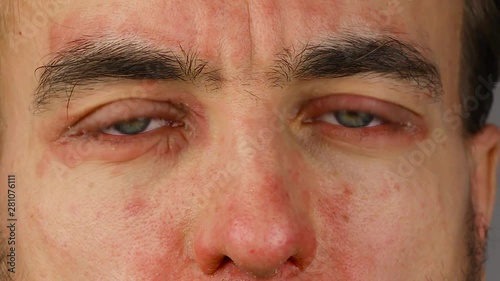 man blinks two of his eyes with red allergic reaction, redness and peeling psoriasis on face skin, seasonal dermatology problem, close-up  