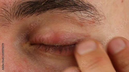 human scratches his left eye with red allergic reaction, redness and peeling psoriasis on face skin, seasonal dermatology problem, close-up macro 