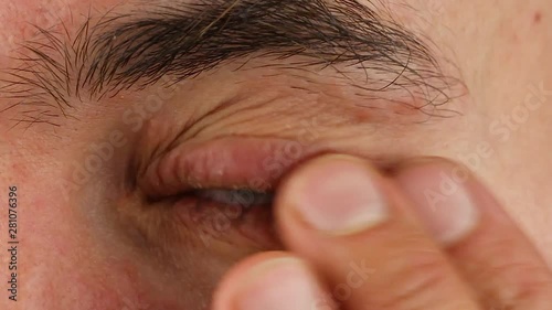 human scratches his left eye with red allergic reaction and blink, redness and peeling psoriasis on face skin, seasonal dermatology problem, close-up macro 