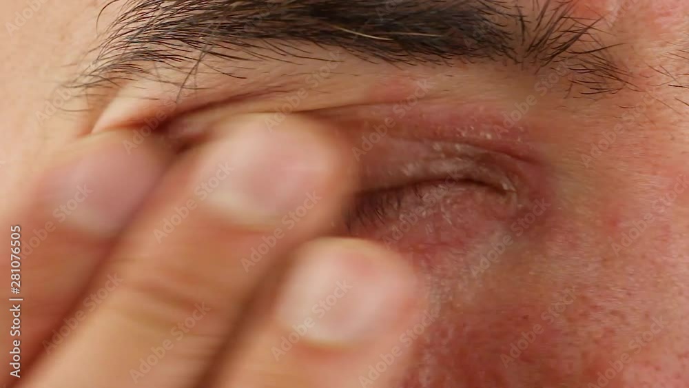human scratches his right eye with inflammation and red allergic reaction, redness and peeling psoriasis on face skin, seasonal dermatology problem, close-up macro 