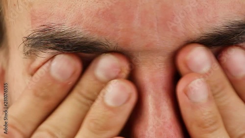 man blinks and scratches his eyes with red allergic reaction, redness and peeling psoriasis on face skin, seasonal dermatology problem, close-up  