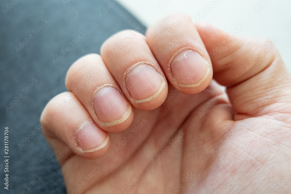 Fingernails that are growing on a person that used to be a nail biter, but has broken the bad habit. You can see lots of scarring and damage from the previous condition. Fingernails that are growing on a person that used to be a nail biter, but has broken the bad habit. You can see lots of scarring and damage from the previous condition.