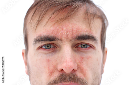 head of sick man with red allergic reaction on facial skin, redness and peeling psoriasis on nose, forehead and cheeks, seasonal skin problem, close-up, white background