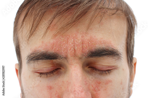 head of sick man with closed eyes with red allergic reaction on skin, redness and peeling psoriasis on nose, forehead and cheeks, seasonal skin problem, close-up, white background