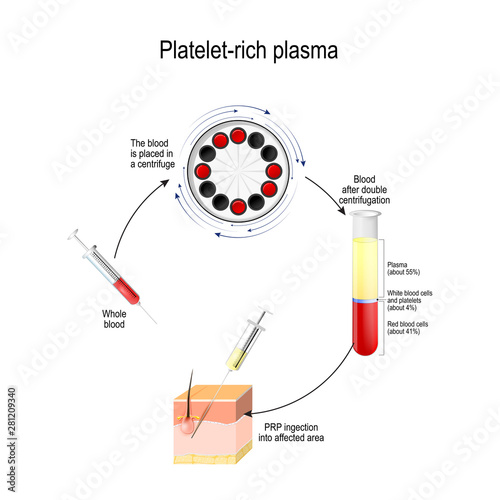 Platelet-rich plasma. PRP is a Medical procedure for Hair growth stimulation