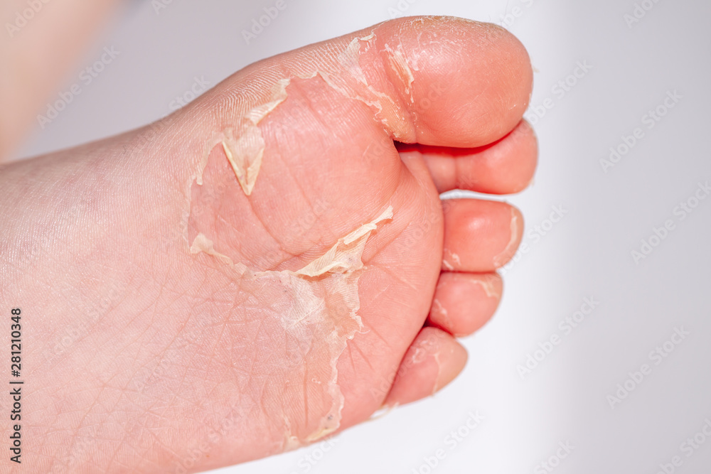 After the red rash and the strawberry tongue caused by scarlet fever the affected skin often peels - Here Skin of foot peeling After the red rash and the strawberry tongue caused by scarlet fever the affected skin often peels - Here Skin of foot peeling
