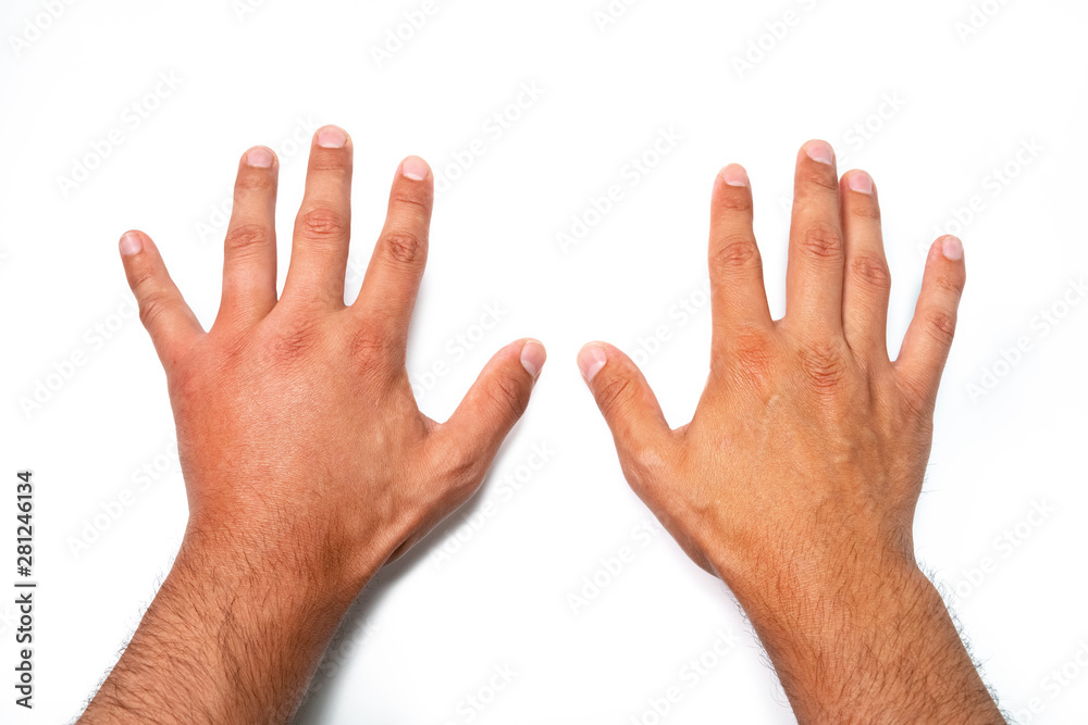 Comparison of two male hands stung by bee or wasp. Hand swelling, inflammation, redness are signs of infection. Insect bite on left hand on white background Comparison of two male hands stung by bee or wasp. Hand swelling, inflammation, redness are signs of infection. Insect bite on left hand on white background