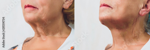 Aged woman doing mesothreads and Thread Lifting, Cosmetology. Cosmetic procedure to eliminate signs of aging. Beauty Face, Facial contour, plastic surgery concept for Age 70-80 years.