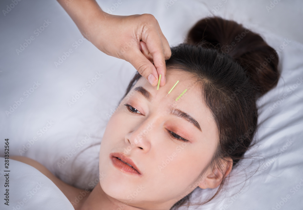 woman undergoing acupuncture treatment on head woman undergoing acupuncture treatment on head
