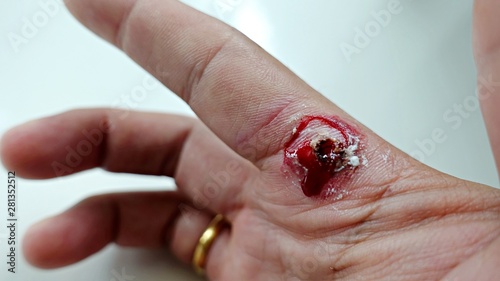 wart on finger and blooding out after treatment by salicylic acid. wart on the finger verruca freeze, healthcare and medical concept, blurred neutral light background from the window, selective focus