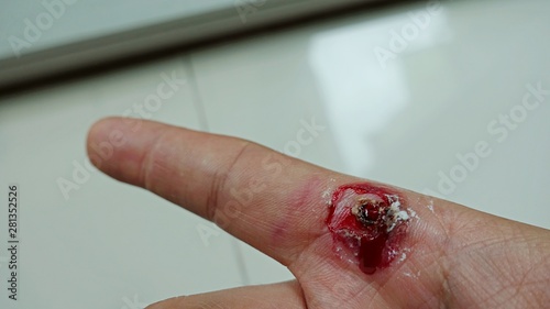 wart on finger and blooding out after treatment by salicylic acid. wart on the finger verruca freeze,  healthcare and medical concept, blurred neutral light background from the window, selective focus