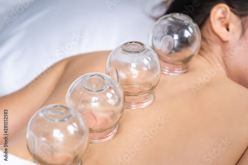 woman receiving cupping treatment on back photo