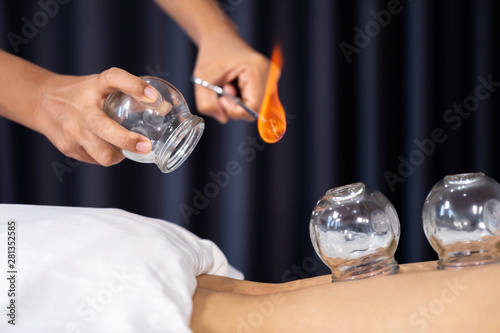 glass cup with fire for cupping treatment on female back