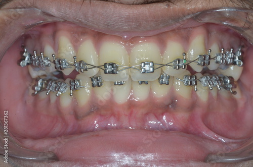 braces treatment for male teeth