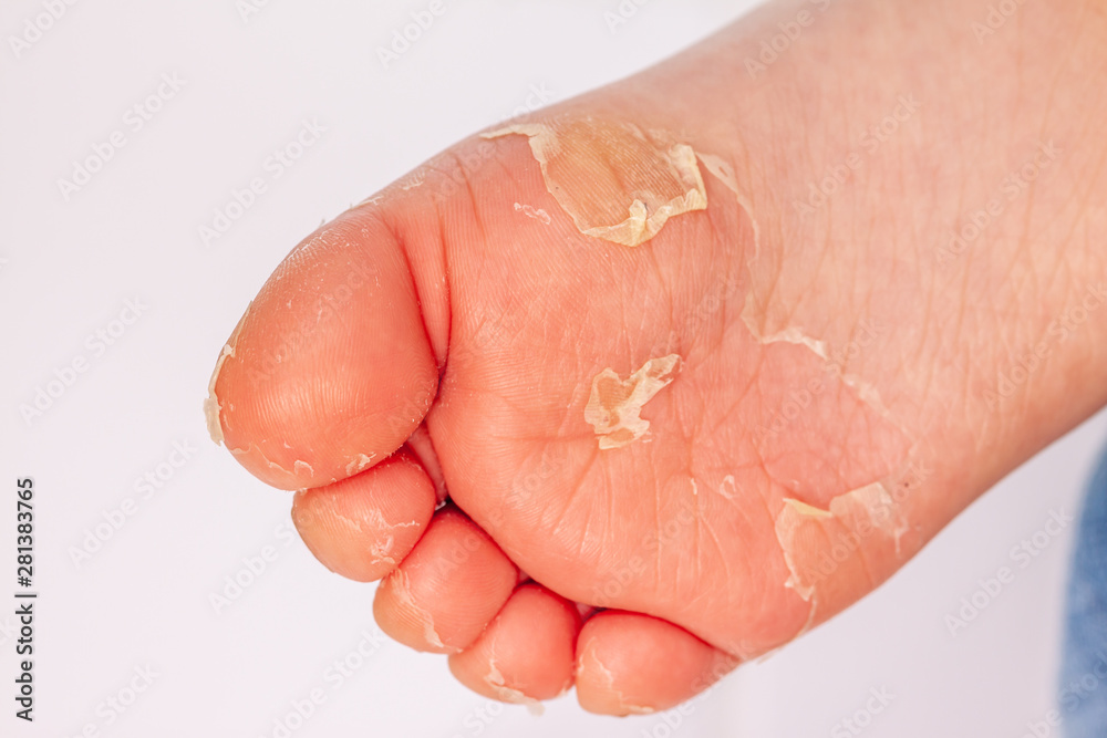 After the red rash and the strawberry tongue caused by scarlet fever the affected skin often peels - Here Skin of foot peeling After the red rash and the strawberry tongue caused by scarlet fever the affected skin often peels - Here Skin of foot peeling