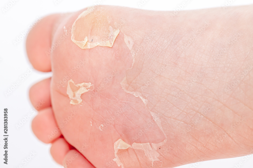 Fototapeta premium After the red rash and the strawberry tongue caused by scarlet fever the affected skin often peels - Here Skin of foot peeling
