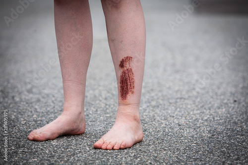 A young woman is standing in the road with bare feet, seen from the front. She has an injury on her leg (shin) that is 3 days healed. A big scab has formed after a falling accident.