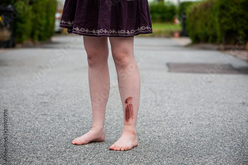 A young woman is standing in the road with bare feet, seen from the front. She has an injury on her leg (shin) that is 3 days healed. A big scab has formed after a falling accident.