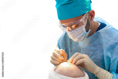 Baldness treatment. Hair transplant. Surgeons in the operating room carry out hair transplant surgery. Surgical technique that moves hair follicles from a part of the head.