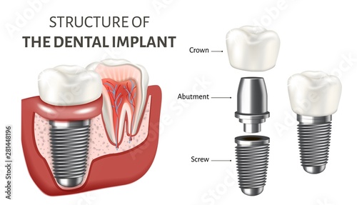 Educational poster showing a structure of the dental implant. Vector illustration isolated on the white background.