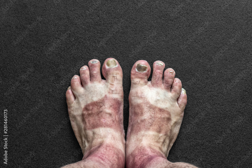 Fototapeta premium Feet with calluses and broken nails