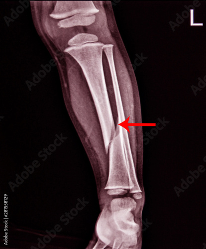 Valokuva X-ray Left Leg AP Lat fracture Tibia.