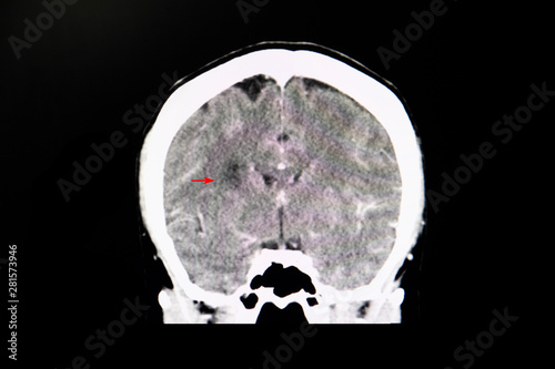 CT brain with contrast of a stroke patient photo