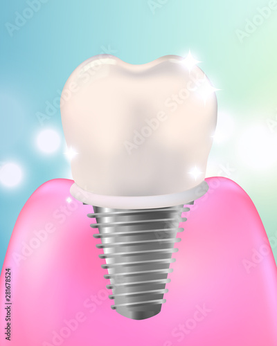 Tooth dental implant 3d . installation of dental implants,crown,abutment,screw.Healthy Tooth ,Under Protection, Teeth Whitening, glowing effect,3D, realistic, Dental design element,
