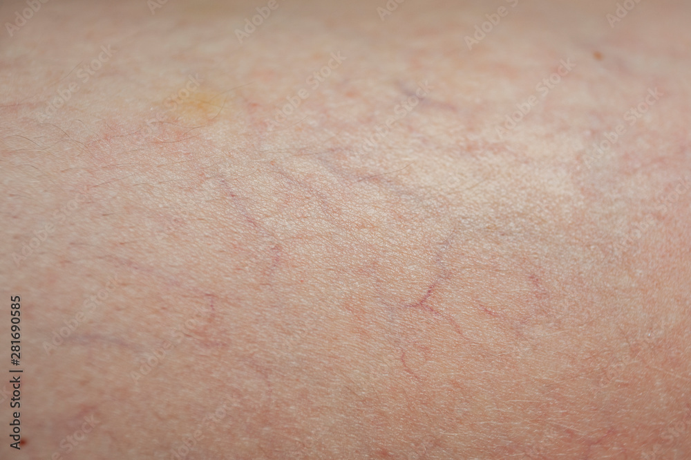 nascent varicose veins, skin background