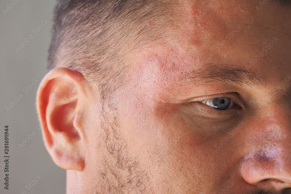 Portrait of a man stung by a wasp in the weighing area. Portrait of a man stung by a wasp in the weighing area.