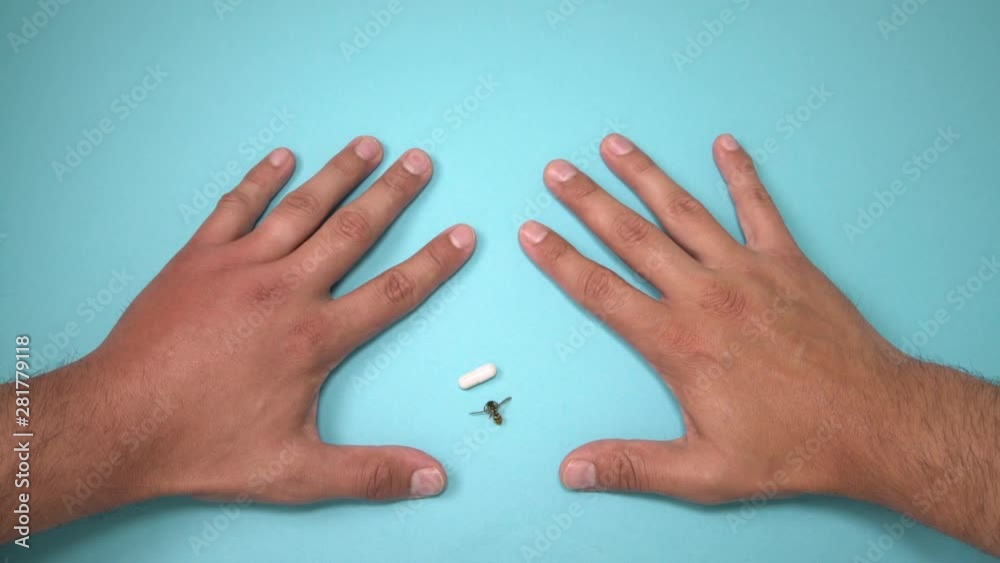 Male hand stung by bee and medication for swelling next to it. Hand swelling, inflammation, redness are signs of infection. Insect bite and pills on blue background Male hand stung by bee and medication for swelling next to it. Hand swelling, inflammation, redness are signs of infection. Insect bite and pills on blue background