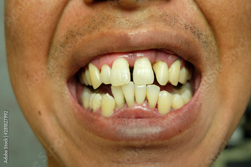 Billede på lærred Close up crooked yellow teeth of men, Gums and teeth that must be maintained by