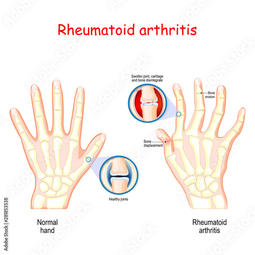 Rheumatoid Arthritis. Healthy hand, and hand with rheumatoid arthritis