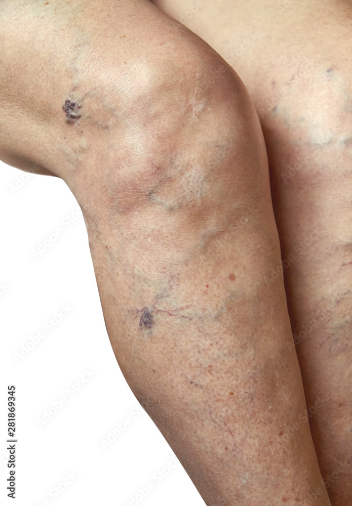 Fototapeta premium Varicose veins on a female legs. Phlebology