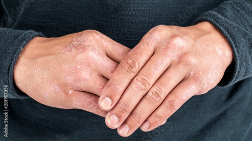 Obraz na plátně Man with sick hands, dry flaky skin on his hand with vulgar psoriasis, eczema and other skin diseases such as fungus, plaque, rash and blemishes