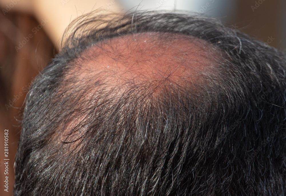 A bald man's head A bald man's head