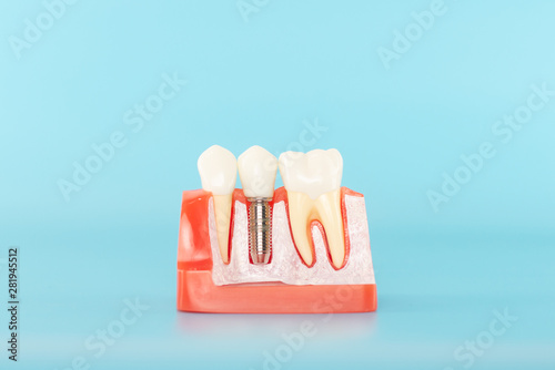 Dental implant model on blue background.