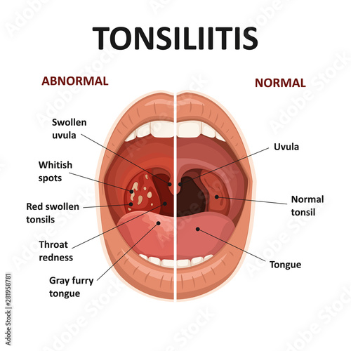 Tonsils and throat diseases. Tonsillitis symptoms. Anatomy of human mouth.