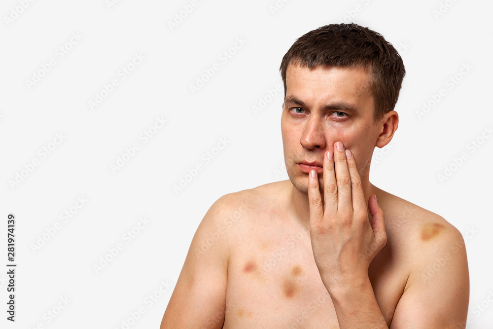 Brunette man with bruises on his body holds his hand to his head in pain after a fight on a white isolated background