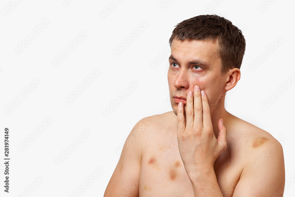 Brunette man with bruises on his body holds his hand to his head in pain after a fight on a white isolated background Brunette man with bruises on his body holds his hand to his head in pain after a fight on a white isolated background