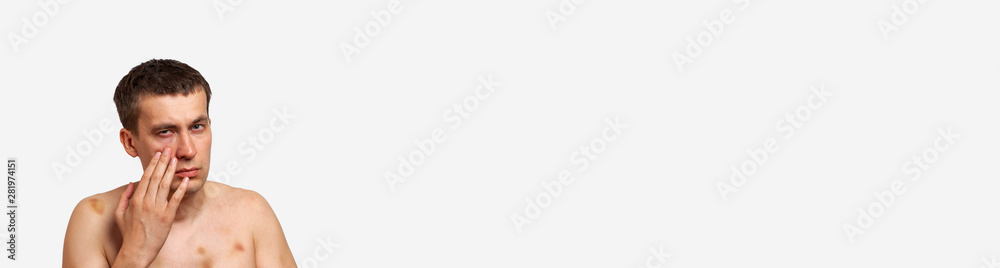 Obraz premium Brunette man with bruises on his body holds his hand to his head in pain after a fight on a white banner isolated background