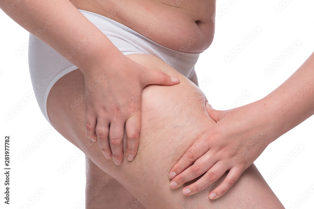 cellulite on legs close up hands squeeze skin